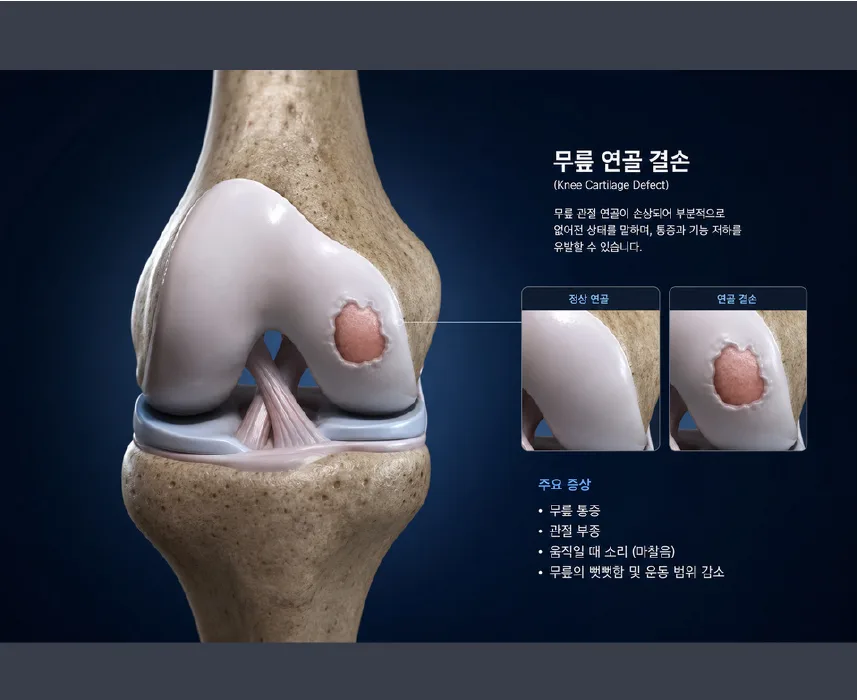 무릎 관절 연골의 국소 결손 부위를 나타낸 3D 의료 일러스트