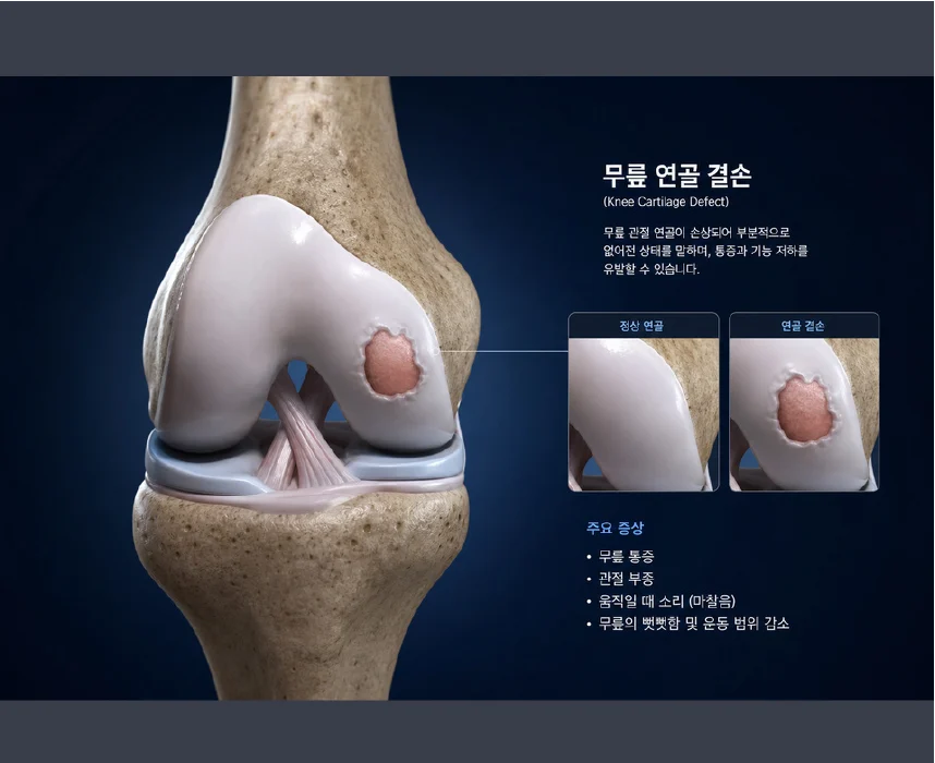 무릎 관절 연골의 국소 결손 부위를 나타낸 3D 의료 일러스트