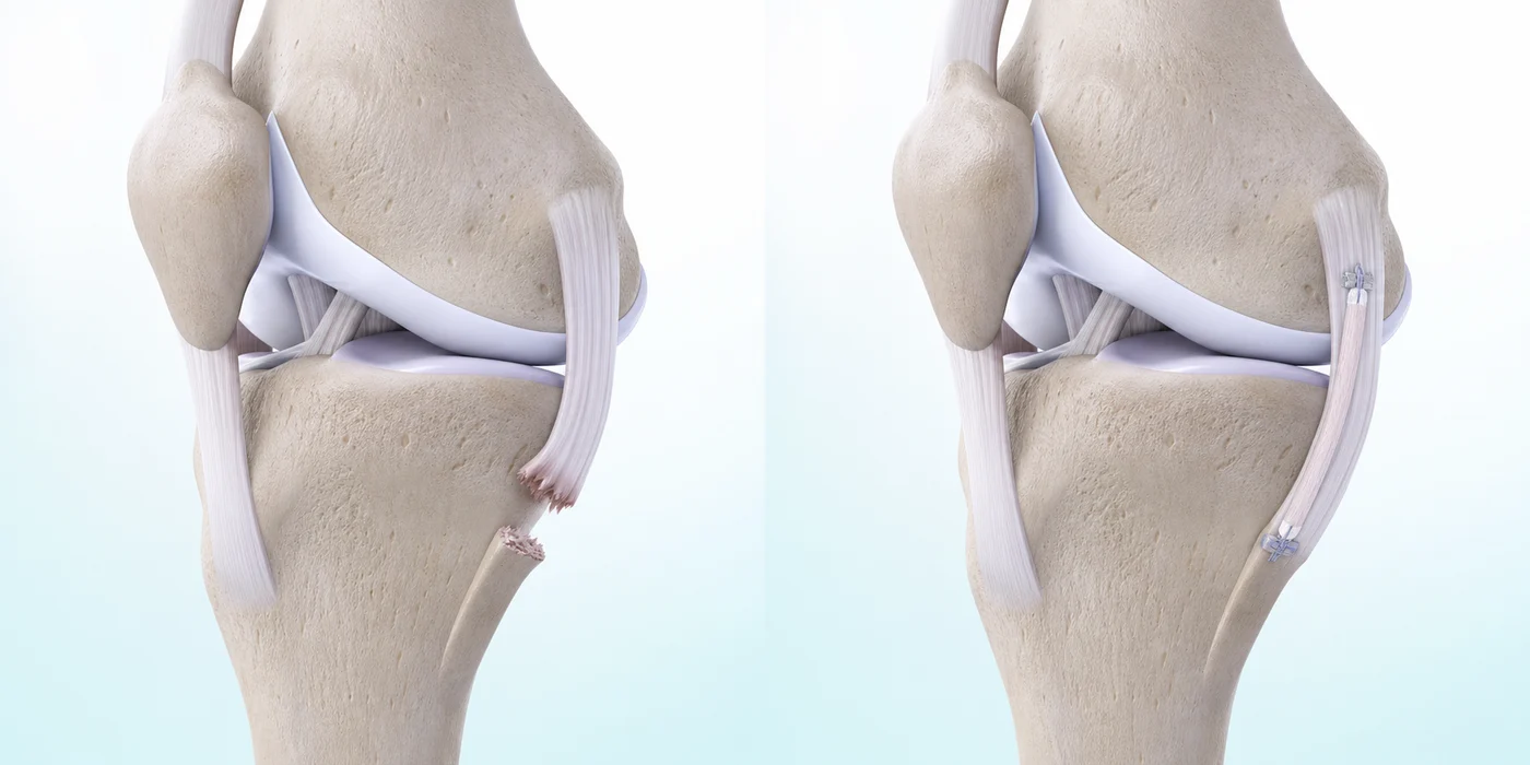 무릎 내측 측부 인대를 봉합하거나 이식건으로 재건하는 과정을 나타낸 AI 기반 3D 의료 일러스트