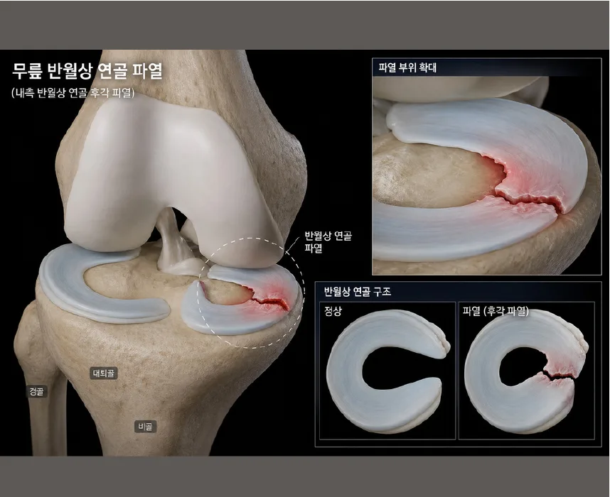 무릎 반월상 연골판 파열 위치를 나타낸 3D 의료 일러스트