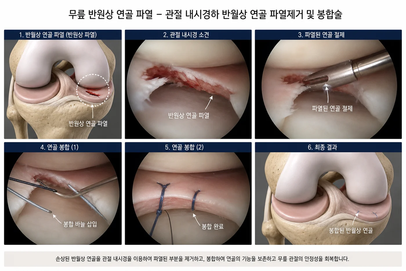 관절경으로 반월상 연골판의 불안정한 손상 조직을 필요한 범위만 정리하는 과정과 봉합 가능한 파열을 봉합하는 과정을 각각 나타낸 3D 의료 일러스트