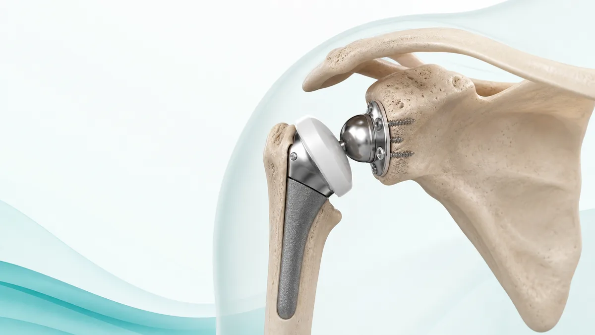 어깨 관절염과 회전근개 기능 저하로 손상된 관절 구조를 나타낸 AI 기반 3D 의료 일러스트