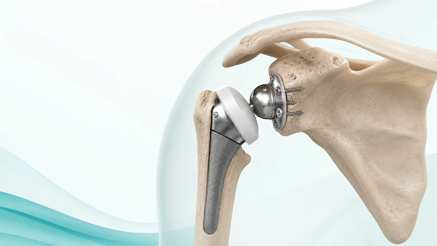 어깨 관절염과 회전근개 기능 저하로 손상된 관절 구조를 나타낸 AI 기반 3D 의료 일러스트