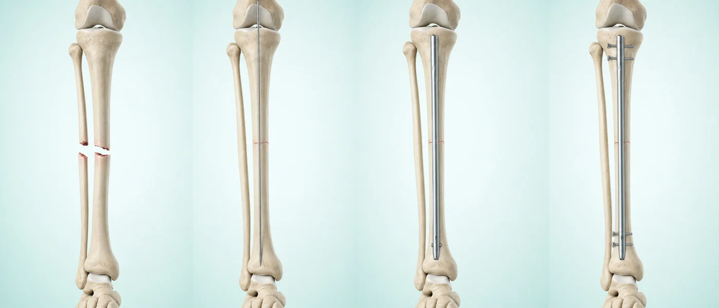 경골 골수강에 금속정을 삽입하고 잠금 나사로 고정하는 과정을 나타낸 AI 기반 3D 의료 일러스트
