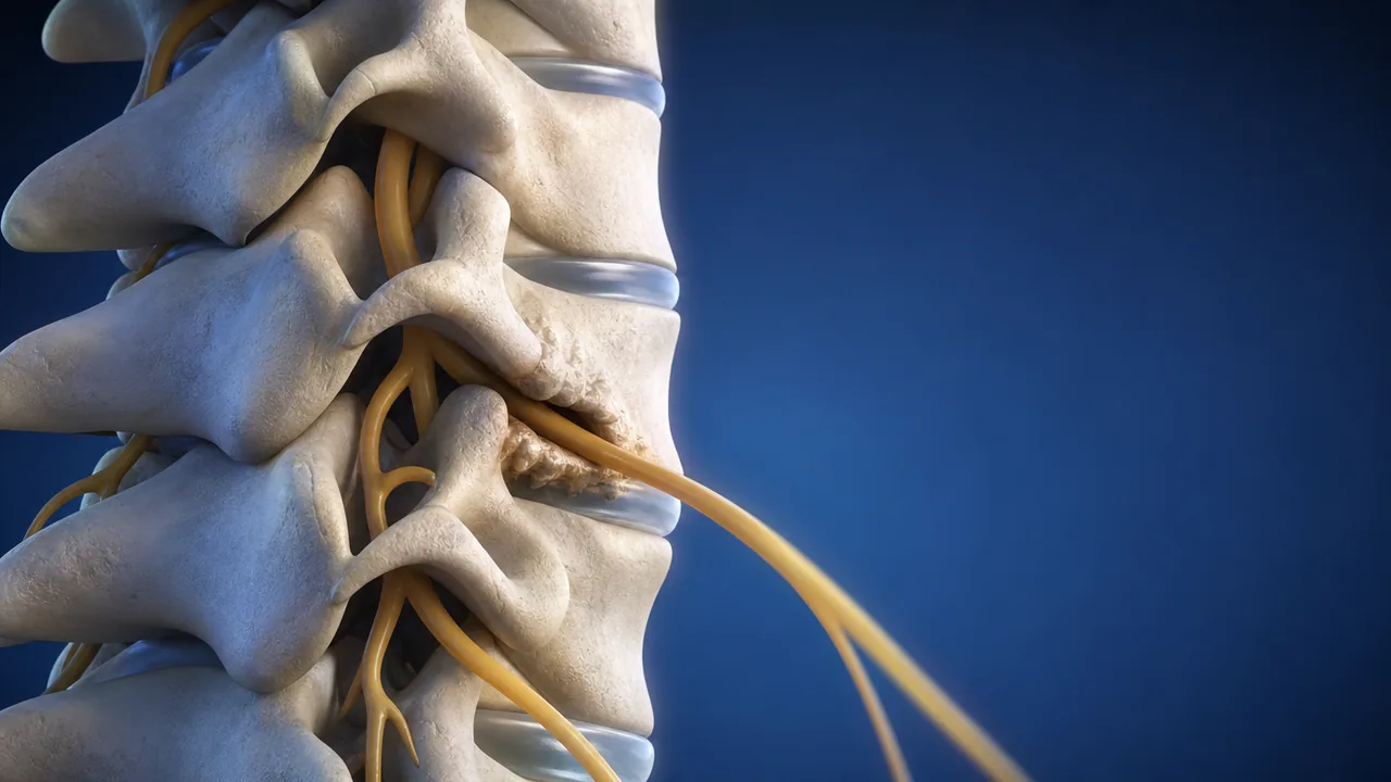 목뼈 신경공이 좁아져 팔로 가는 신경근이 눌리는 모습의 3D 해부 일러스트